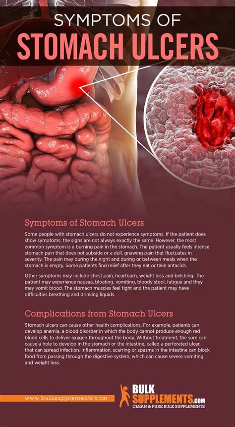 Can you have a stomach ulcer without bleeding?