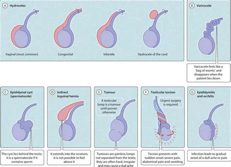 Can you have a testicular cyst for years?