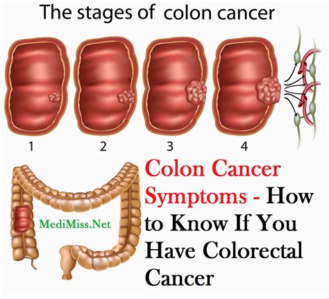 Can you have colon cancer for 2 years and not know?