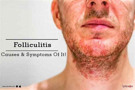 Can you have folliculitis without pus?