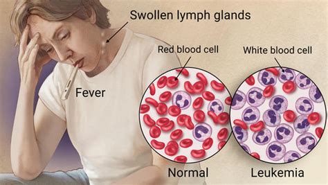 Can you have leukemia without fever?