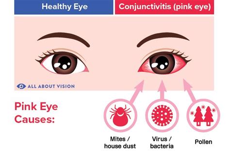 Can you have pink eye without red eyes?