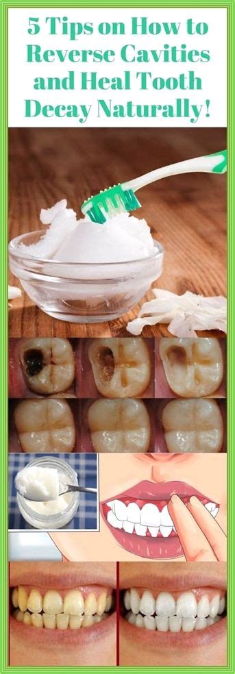 Can you heal a cavity naturally?