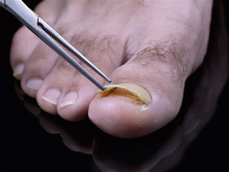 Can you heal a dead nail?