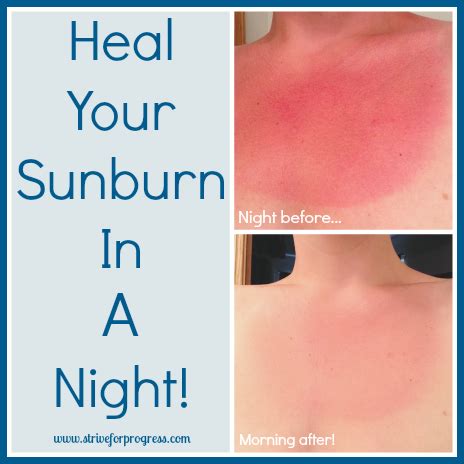 Can you heal sunburn in a day?