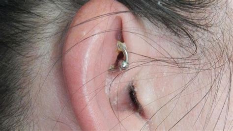 Can you keep an earring in an infected piercing?