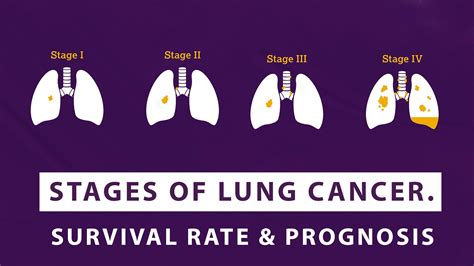 Can you live 10 years with Stage 4 lung cancer?