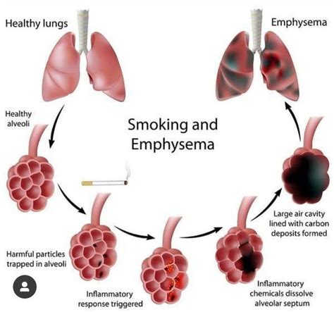 Can you live 20 years with mild emphysema?