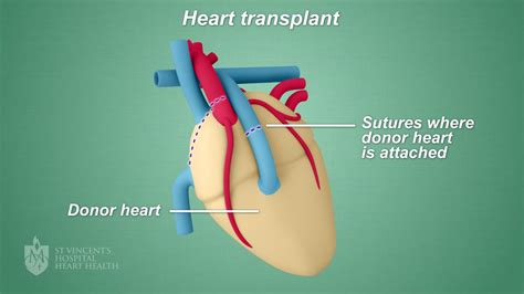 Can you live 30 years after heart transplant?