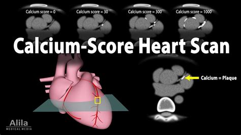 Can you live a long life with a high calcium score?