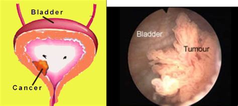 Can you live a long life with bladder cancer?