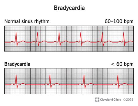 Can you live a long life with bradycardia?