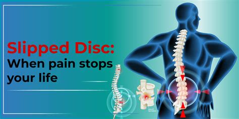 Can you live normal life after slip disc?