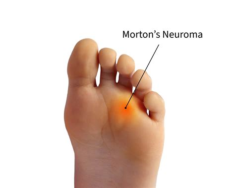 Can you live with Morton's neuroma?
