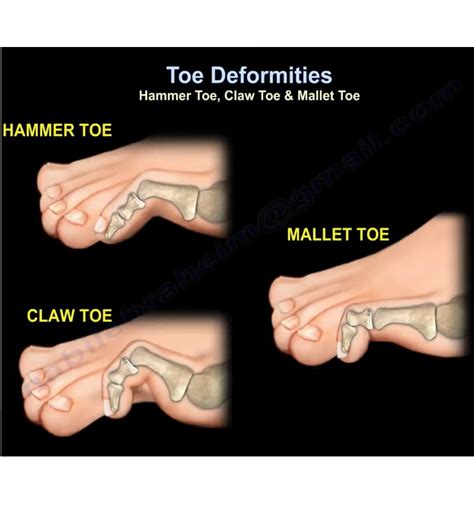 Can you live with a hammer toe?
