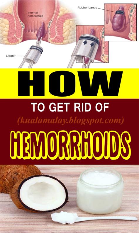 Can you live with hemorrhoids without surgery?