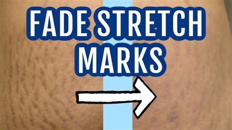 Can you make stretch marks fade faster?