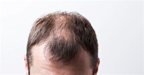 Can you permanently fix balding?