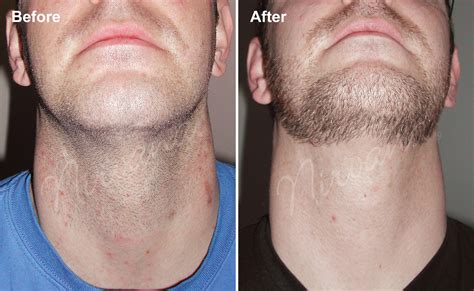Can you permanently remove neck hair?