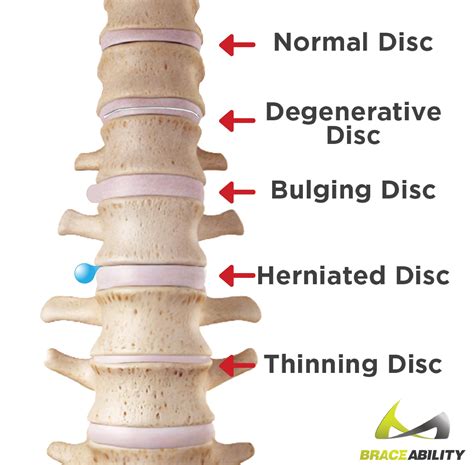 Can you physically feel a bulging disc?