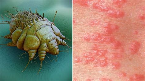 Can you physically see scabies mites?