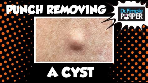 Can you poke a hole in a cystic pimple?