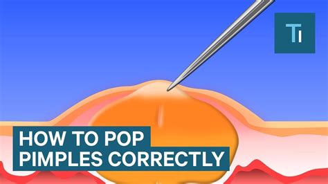 Can you pop a hair bump with a needle?