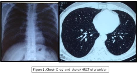 Can you prevent welders lung?