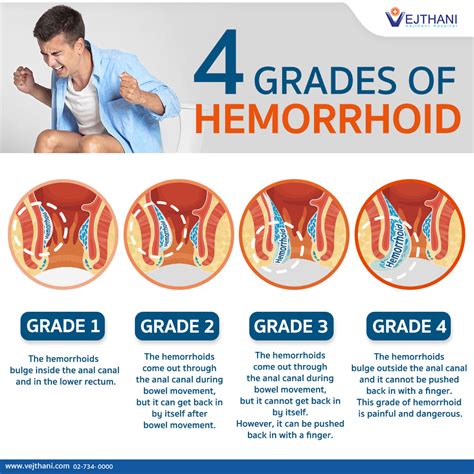 Can you push a grade 4 hemorrhoid back in?