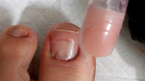 Can you put a fake nail on a missing toenail?