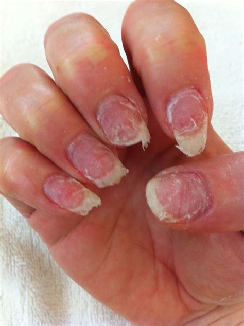 Can you put fake nails on damaged nails?