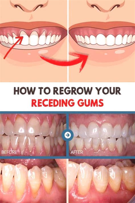 Can you rebuild gum tissue?