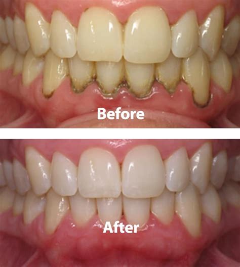 Can you recover from early periodontitis?