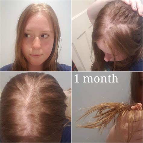 Can you recover from thin hair?