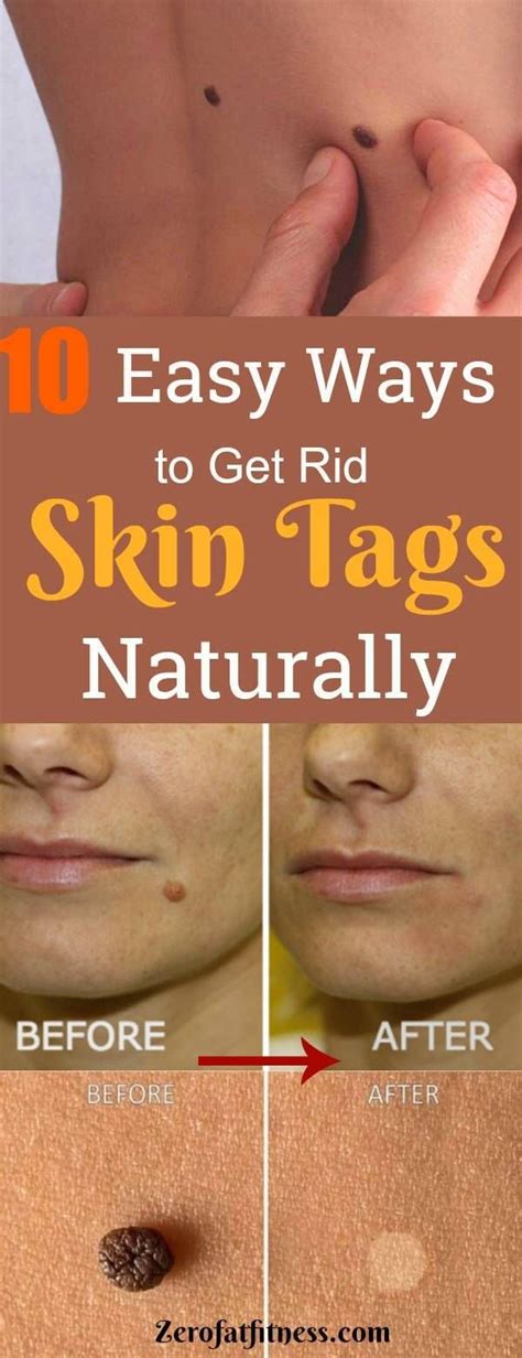 Can you remove skin tags at home?