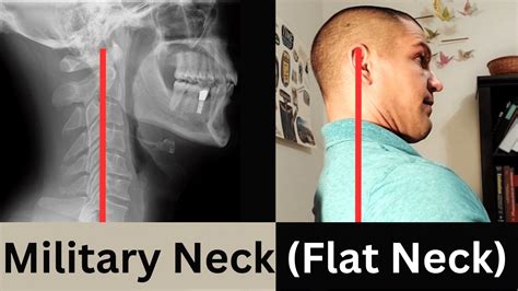 Can you restore military neck?