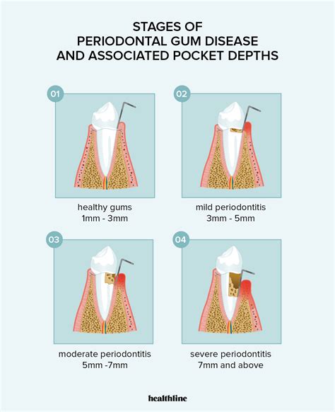Can you reverse 4mm gum pockets?