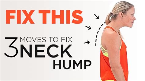 Can you reverse a hunched neck?