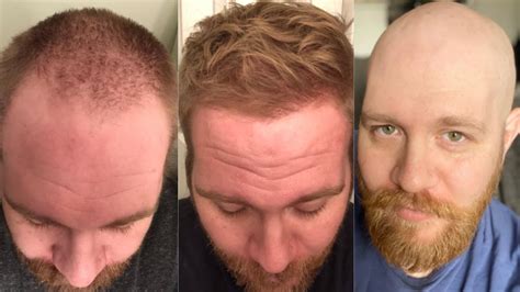 Can you reverse frontal balding?