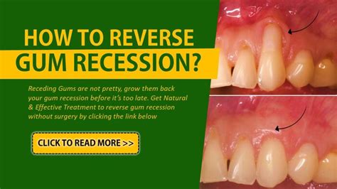 Can you reverse gum disease yourself?