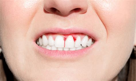 Can you reverse periodontitis naturally?