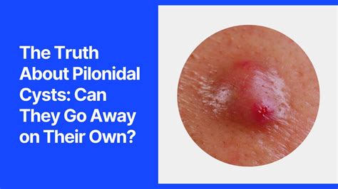 Can you rub a cyst away?