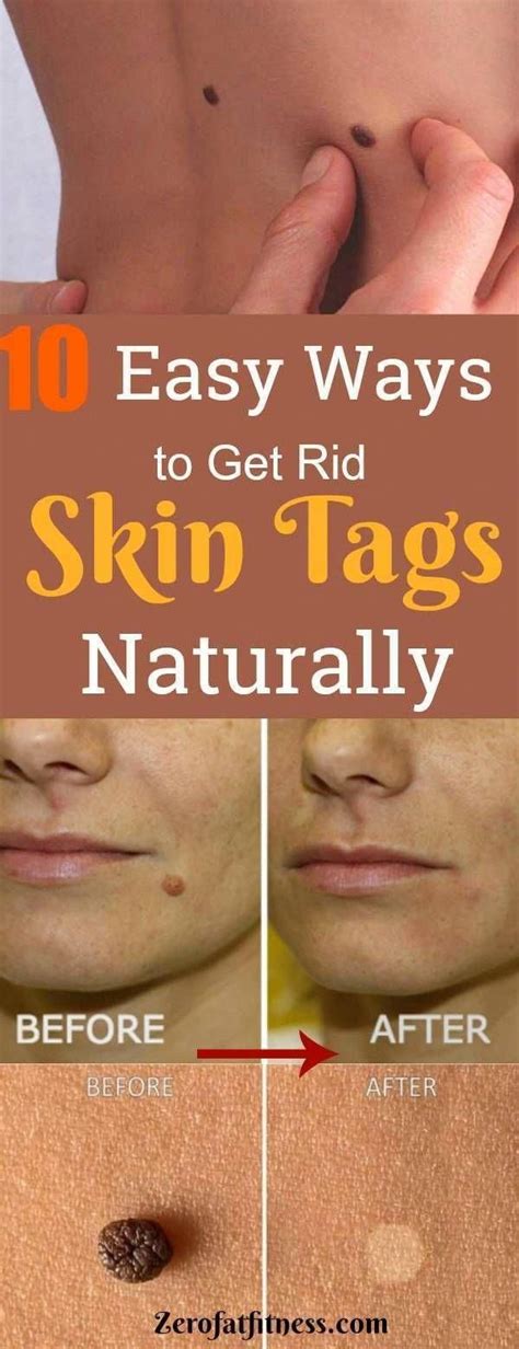Can you safely remove skin tags yourself?