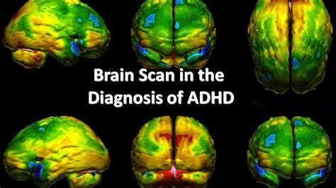 Can you see ADHD on a brain scan?