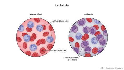 Can you see leukemia in blood?