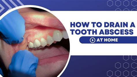 Can you self treat a mouth abscess?