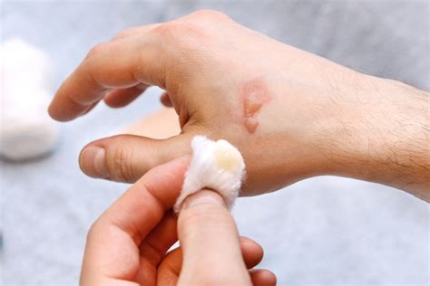 Can you shower with burn blisters?