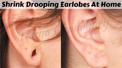 Can you shrink ear holes?