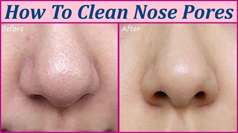 Can you shrink your nose hole?