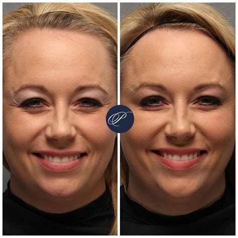 Can you smile after Botox?
